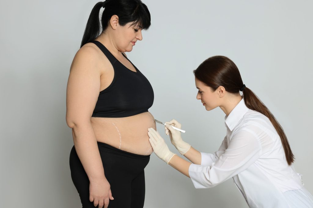 Cirugía bariátrica: una solución segura para combatir la obesidad