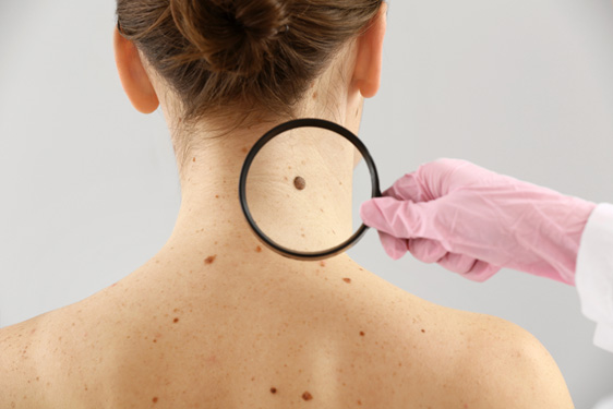 Recomendaciones claves para prevenir el cáncer de piel