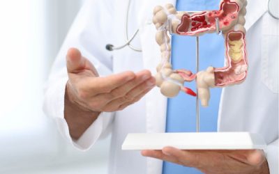 Descarte de Cáncer de Colon