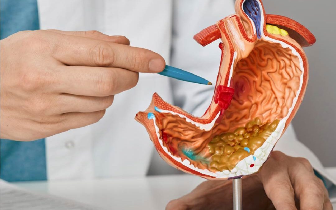 Descarte de Cáncer de Estómago